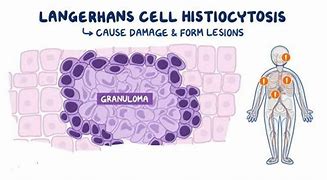 Image result for Immature Langerhans Cells