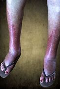 Image result for Rash On Foot and Ankle