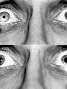 Image result for Pupillary Reaction Disorders