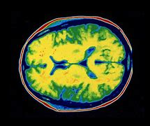 Image result for CT Scan of Brain Scar