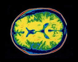 Image result for CT Scan Brain Parts