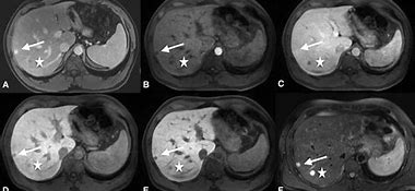 Image result for Hemangioma Liver MRI