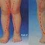 Image result for Rontgen Tulang Kaki