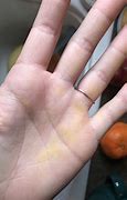 Image result for Yellow Skin Spots