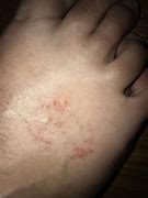 Image result for Rash On Foot and Ankle