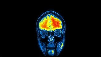 Image result for Computed Tomography Brain Scan