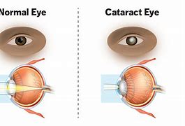 Image result for Diabetic Cataract