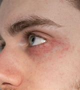 Image result for Allergic Rash around Eyes