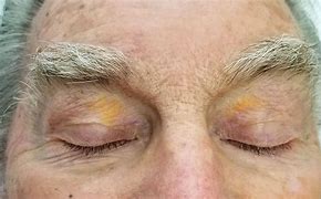 Image result for Yellow Skin Spots