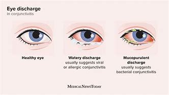 Image result for Pink Eye or Allergies