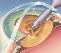 Image result for Cataract Extraction