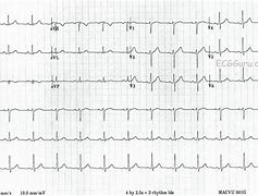 Image result for 12 Lead EKG Strip Phillips