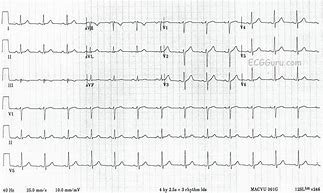 Image result for 12 Lead EKG Clip Art