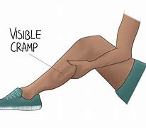 Image result for Muscle Cramps