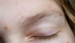 Image result for Eyes Red and Itchy