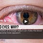 Image result for Pink Eye or Allergies