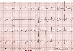 Image result for 12 Lead EKG Strip Phillips