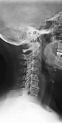 Image result for Subluxation Complex