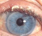 Image result for Blepharitis Pics