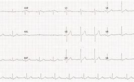 Image result for 12 Lead EKG Strip Phillips