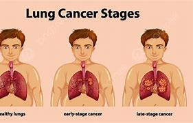 Image result for Stage 4 Cervical Cancer