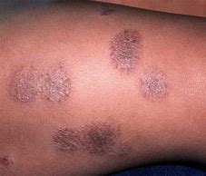 Image result for Eczema Treatments Adults