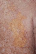 Image result for Yellow Skin Spots