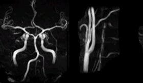 Image result for Vertebral Artery Dissection Symptoms