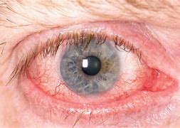 Image result for Uveitis