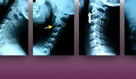 Image result for Subluxación Vertebral