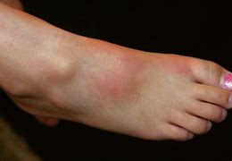 Image result for Rash On Foot and Ankle