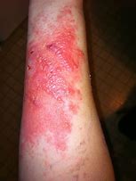 Image result for Poison Ivy Symptoms