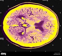 Image result for CT Scan Brain Parts