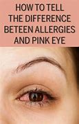 Image result for Pink Eye or Allergies