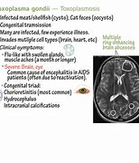 Image result for Toxoplasmosis Gondii