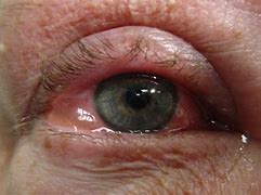 Image result for Itchy Eyes Allergies