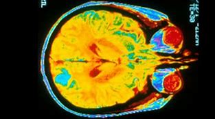 Image result for Parkinson's Brain MRI