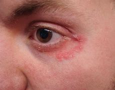 Image result for Allergic Rash around Eyes