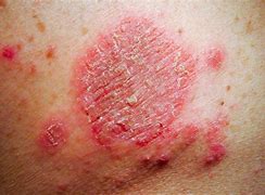 Image result for Eczema Dark Skin Treatment