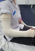 Image result for Broken Arm Cast Elbow