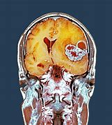 Image result for CT Scan of Brain Scar