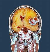 Image result for Parkinson's Brain MRI