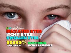 Image result for Itchy Eyes Allergies