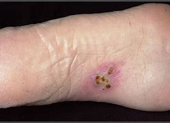 Image result for Rash On Foot and Ankle