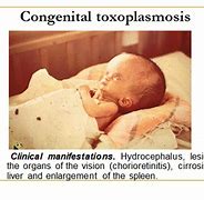 Image result for Toxoplasmosis Gondii