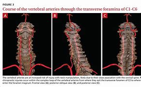 Image result for Vertebral Artery Dissection Symptoms