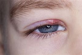 Image result for Stye On Eyelid