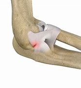 Image result for Ulnar Collateral Ligament Elbow