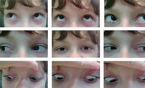 Image result for Conjugate Eye Movement