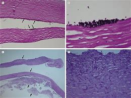 Image result for Keratitis